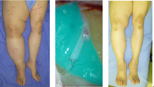 LVA for compression-refractory lymphedema
